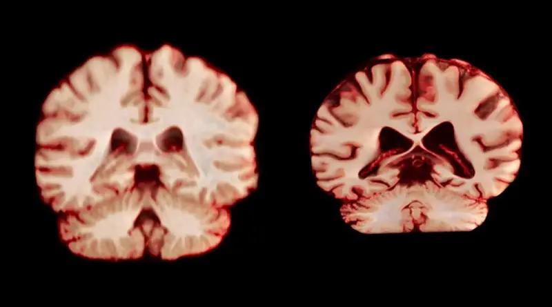 El cerebro de los hombres envejece más rápido: ¿por qué?