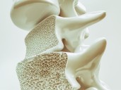 Cada minuto ocurren 70 fracturas por osteoporosis en el mundo