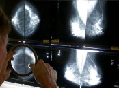 Cáncer de mama: a qué edad es poco frecuente y por qué el autoexamen ya no es útil