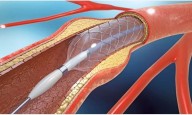 New Drug-Eluting Balloon Matches Standard Stents in Safety and Effectiveness: SELUTION4ISR Trial