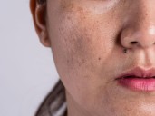 ¿Manchas en la piel? Estos son los ingredientes que ayudan a unificar el tono