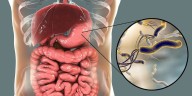 La infección crónica por esta bacteria es la causa principal del cáncer de estómago