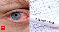 High uric acid is dangerous for your eyes: Understanding the risks of glaucoma, dry eyes, retinal damage, and more