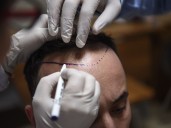 How one country has become a top destination for hair transplants