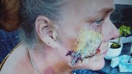 Caregiver recovering after dog mauling in Cocoa faces long road to healing