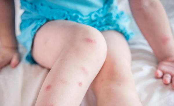 Fiebre de Oropouche: alertan que ya circula en el país