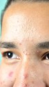 7 Natural Ways to Treat Acne from the Root