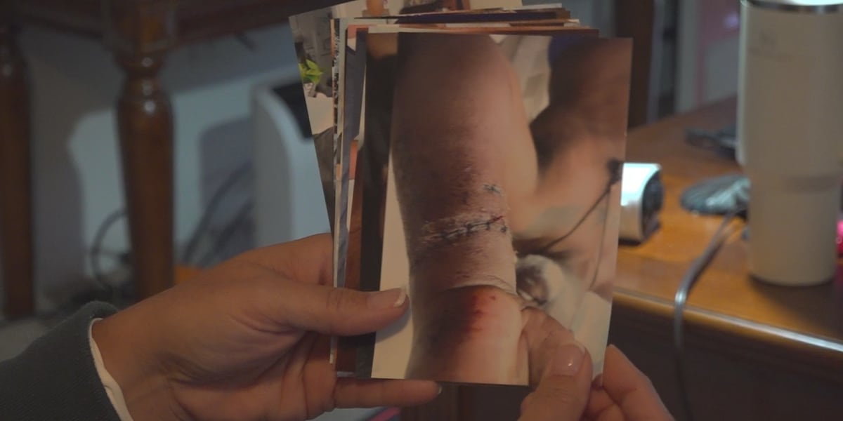 Victims speak out after dog attack
