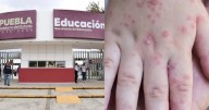 Más de 400 alumnos contagiados del virus Coxsackie en Puebla; suspenden clases en 77 escuelas