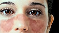 Entre Ríos se suma a campaña nacional para visibilizar el lupus