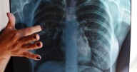 Sonora registra 1,322 casos de tuberculosis; Hermosillo concentra 51.2%