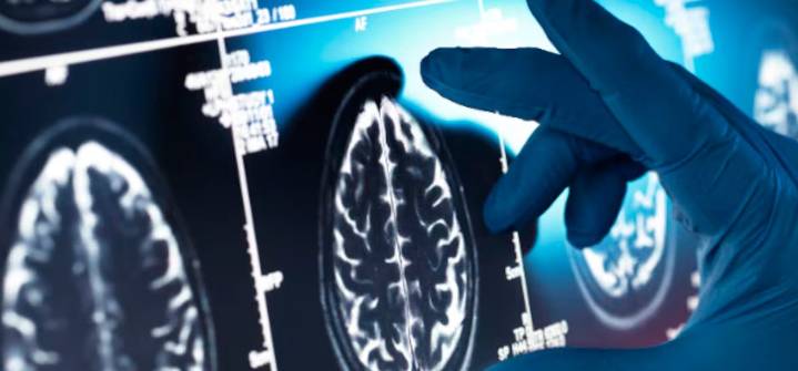 Estudio revela que hasta el 45% de los casos de Alzheimer podrían prevenirse