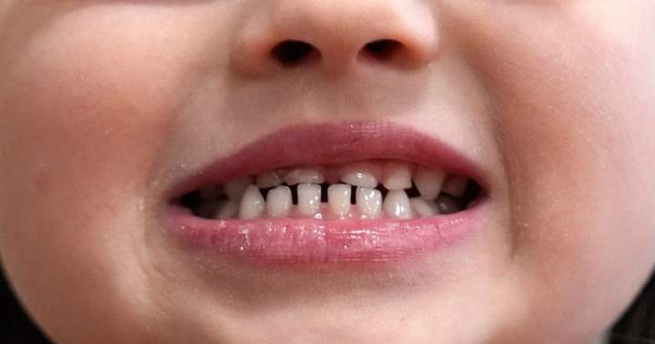 FDA restricts use of kids’ fluoride supplements citing emerging health risks