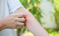 Región Centro suma 74 contagios de dengue y refuerza prevención
