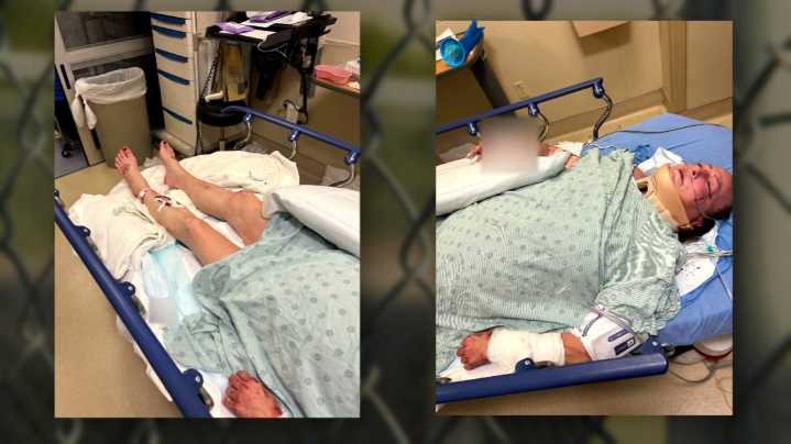 North Texas woman recovering after violent dog attack at park