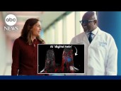 How AI detection helped an Iowa mom with breast cancer avoid a mastectomy