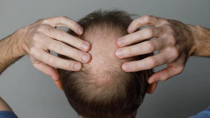 Descubren una posible 'cura' para la calvicie que podría lograr el crecimiento del pelo en 20 días