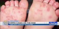 Hand Foot and Mouth disease cases on the rise