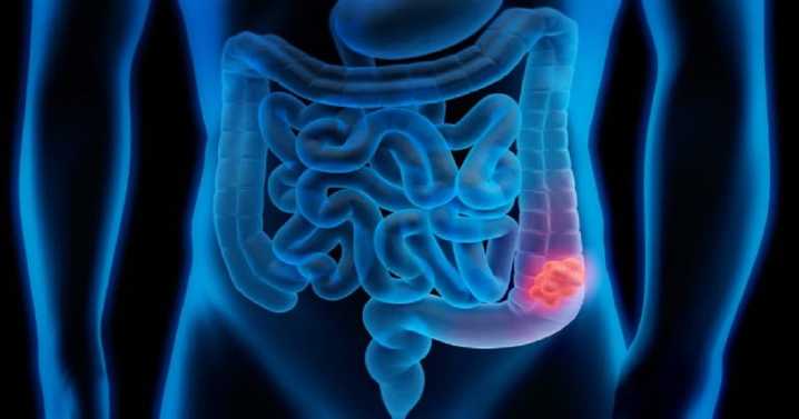Cáncer de colon: ¿Por qué aparece?