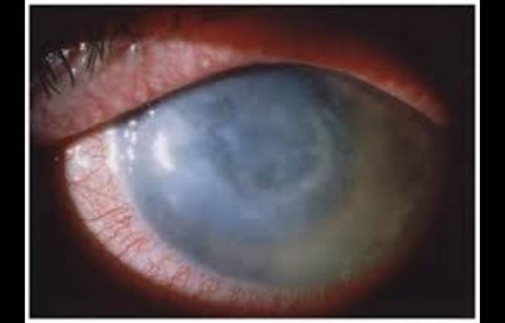Early Detection and Treatment Key in Managing Acanthamoeba Keratitis, reveals research
