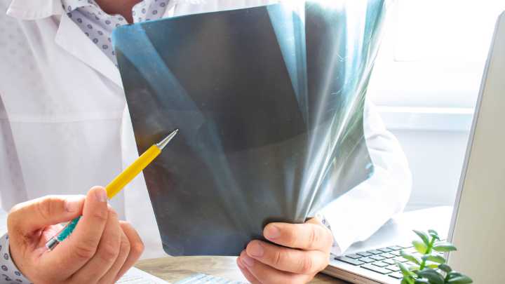 Científicos crean 'nanocemento óseo' que acelera la recuperación de fracturas graves: así funciona el invento que revoluciona la salud de los huesos