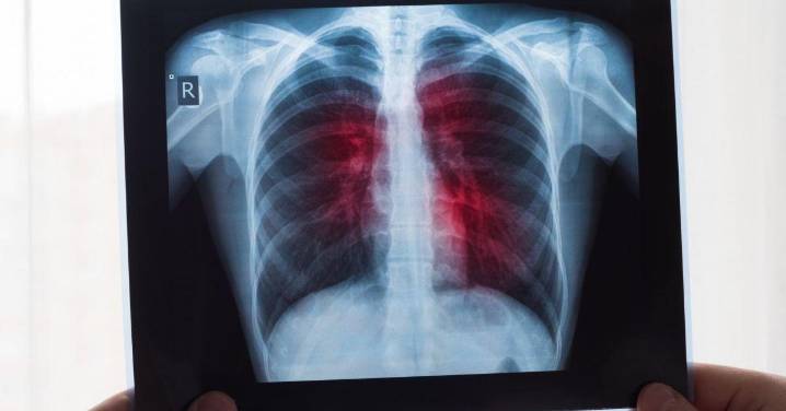 Un modelo de IA estima el riesgo de cáncer de los nódulos pulmonares