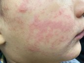 Measles exposure warning from Ottawa Public Health