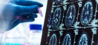 Científicos visualizan por primera vez el desencadenante del párkinson en el cerebro