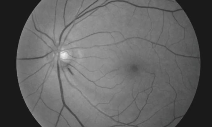 Nocturnal Blood Pressure Dips Linked to Rapid Central Vision Loss in Normal
