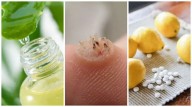 Elimina las verrugas de tu cuerpo con estos eficaces remedios