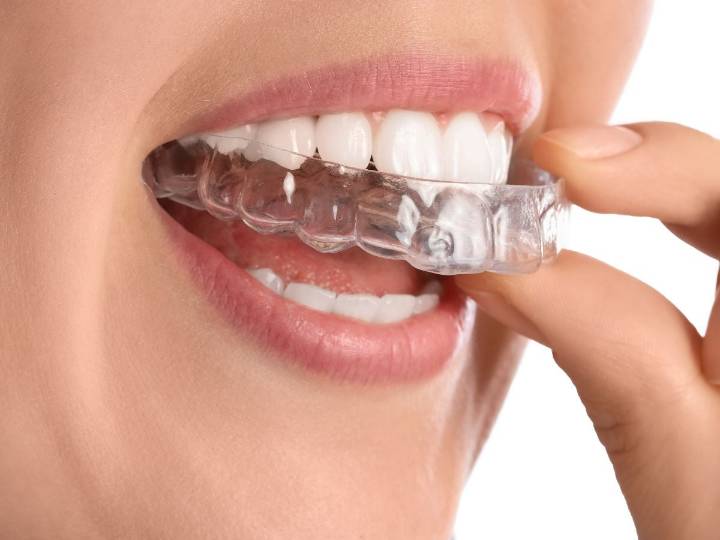 Alineadores transparentes: la verdad que los ortodoncistas advierten antes de usarlos