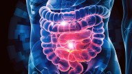 Adding Immunotherapy to Chemoradiotherapy in Rectal Cancer Shows Safety, No Efficacy Gain