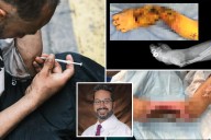 Inside the worse 'tranq' cases surgeons are treating
