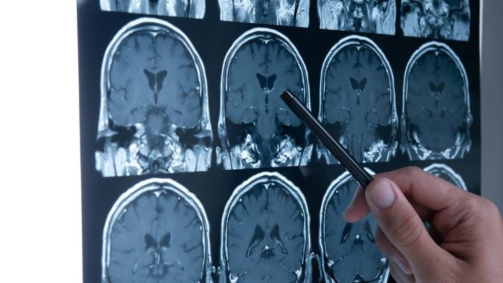 Los consejos de la neuróloga para que el ictus, la primera causa de muerte en mujeres, no nos mate