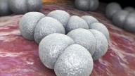 Adult hospitalised with life-threatening meningococcal disease