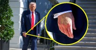 Donald Trump, 79, Coats Bruised Hand in Makeup After 4