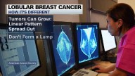 What to know about the lesser-known breast cancer type on the rise