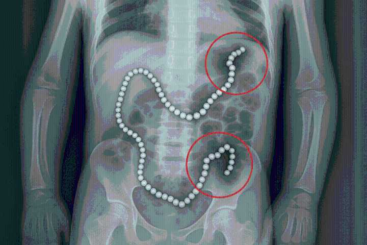 Adolescente pierde parte del intestino tras ingerir más de 100 imanes de neodimio