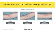 FDA Approves Zoryve for Atopic Dermatitis in Young Children