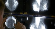 Hard-to-detect breast cancer cases rising at alarming rate, new research shows