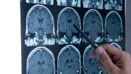 Los consejos de la neuróloga para que el ictus, la primera causa de muerte en mujeres, no nos mate