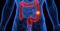 Bleeding Tied To Colon Cancer Risk Among Young Adults