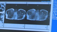 Doctors and patients urge lawmakers to remove barriers to early prostate cancer