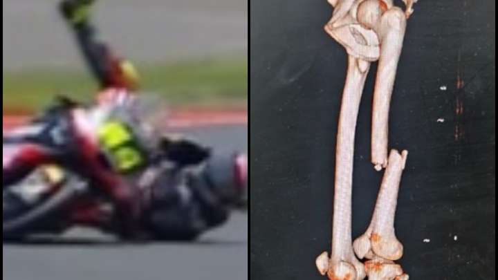 Tremendo: David Muñoz desvela la terrible imagen de su fractura de fémur tras la caída en Indonesia