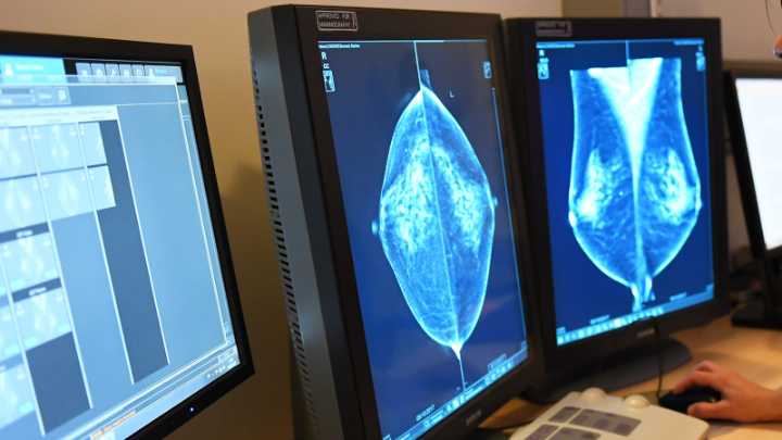 Así puede ayudar la impresión 3D a detectar el cáncer de mama
