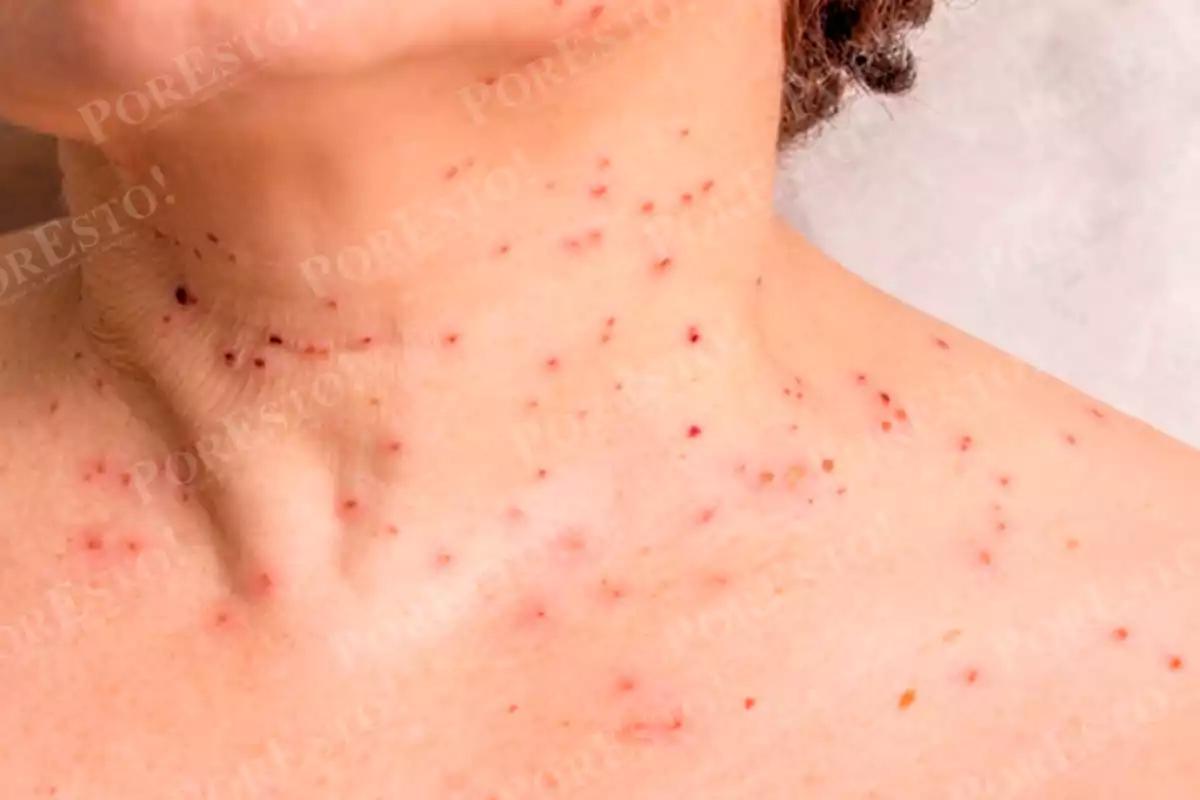 Se duplican casos de papiloma humano en Campeche