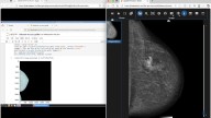 La UPV participa en proyecto europeo de detección temprana de cáncer de mama mediante Inteligencia Artificial