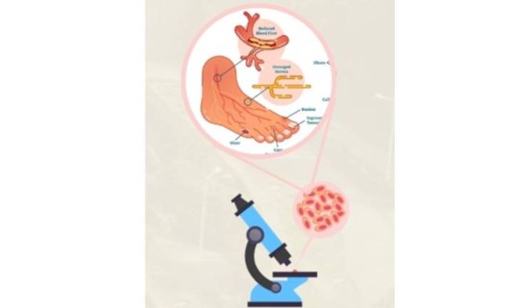 Nagaland University researchers find plant compound to treat diabetic wound, foot ulcers