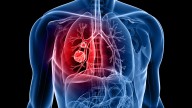 'Zepzelca' el nuevo fármaco español aprobado por EEUU para tratar el cáncer de pulmón