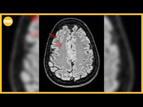 What to know about whole-body MRI scans